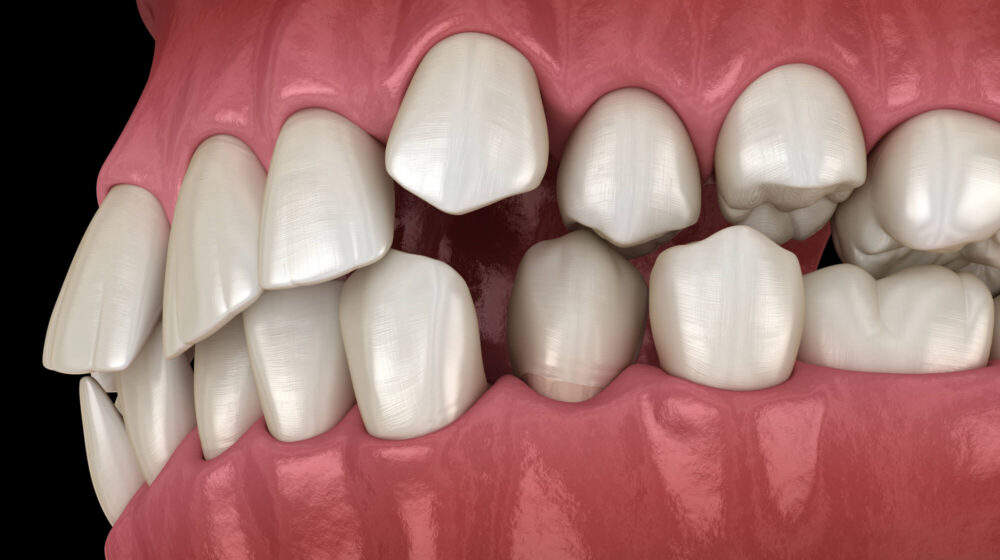 How to Fix Crooked Teeth Without Braces