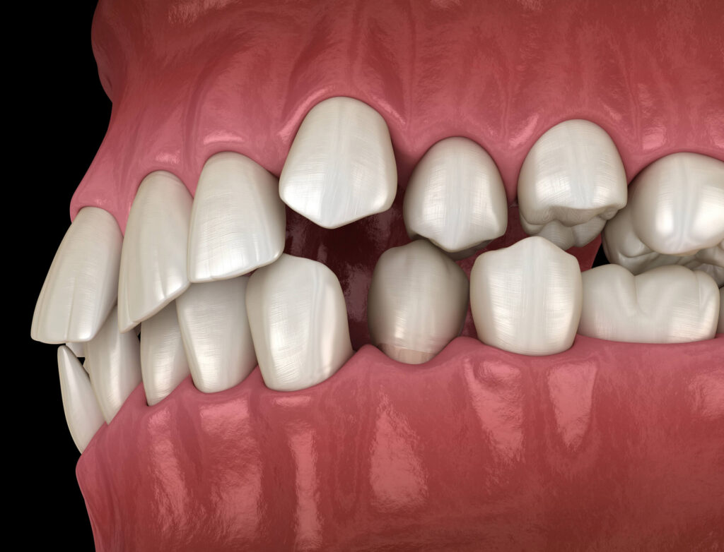 How to Fix Crooked Teeth Without Braces
