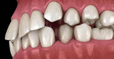 How to Fix Crooked Teeth Without Braces