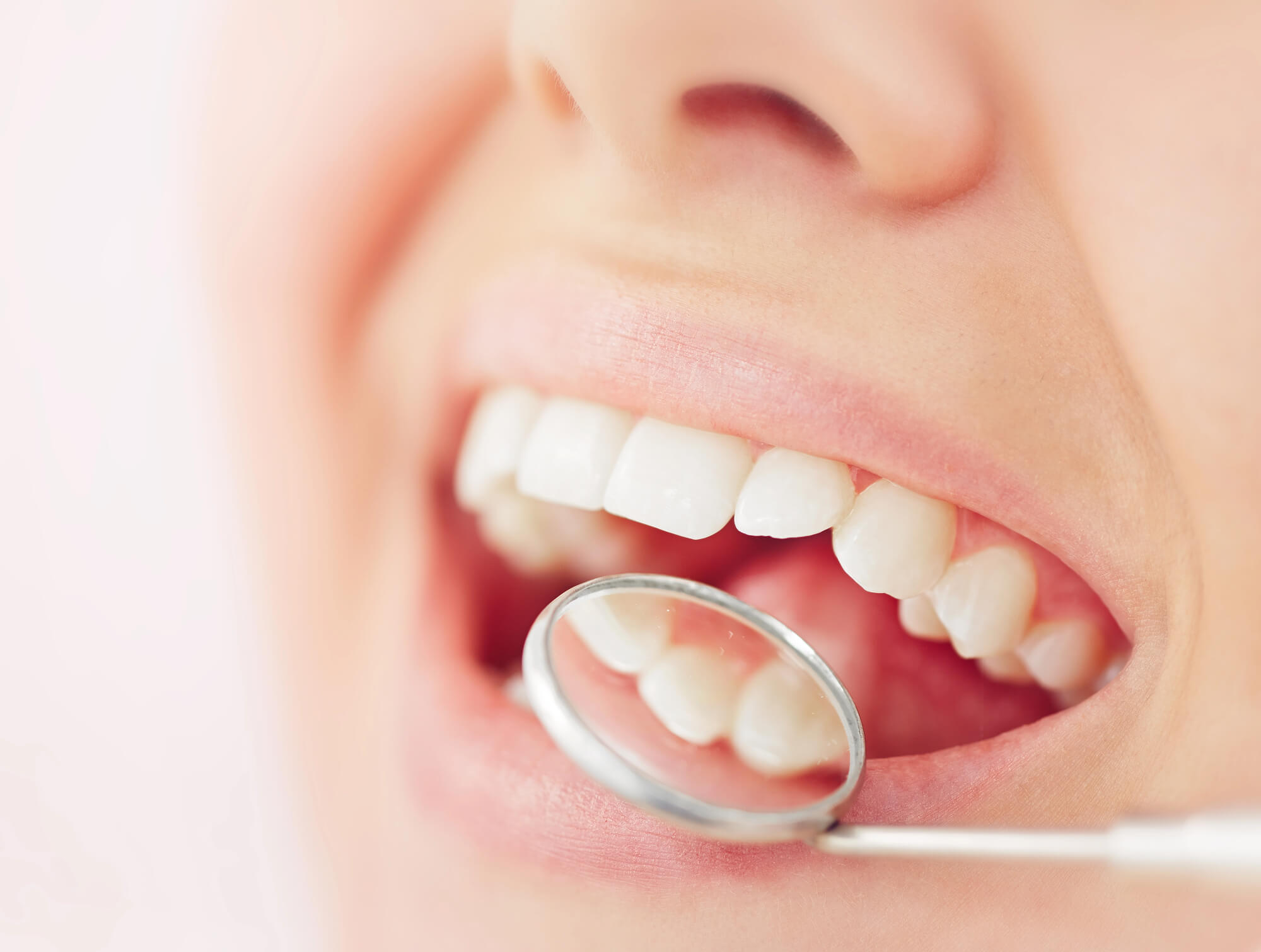 White Spots on Teeth