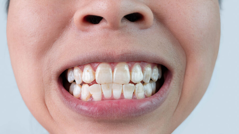 White Spots on Teeth