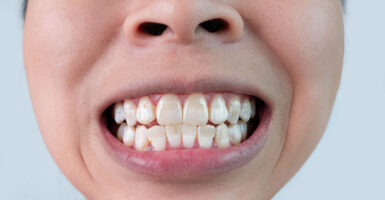 White Spots on Teeth