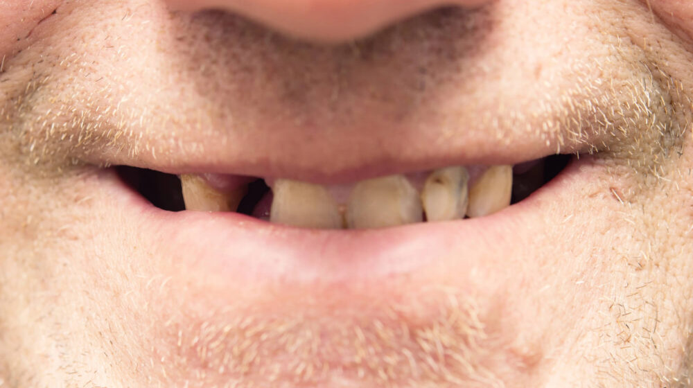 Worn Down Teeth