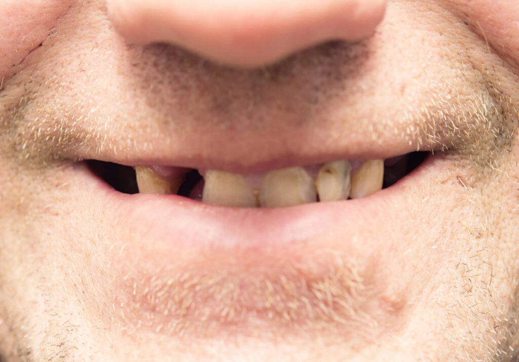Worn Down Teeth