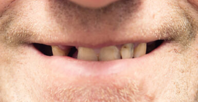 Worn Down Teeth