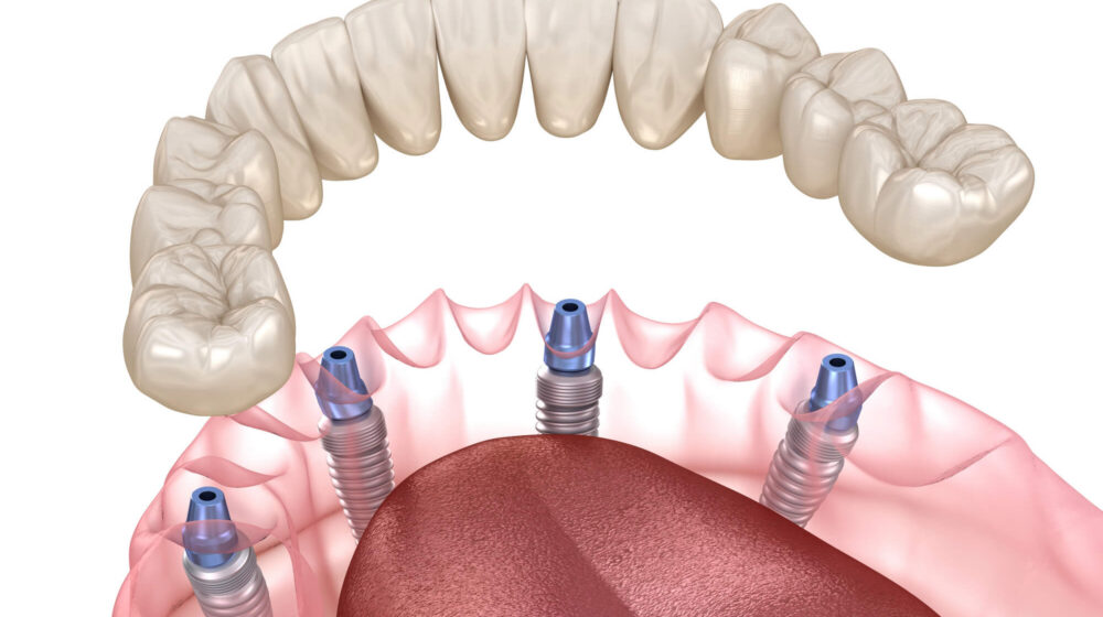 All-on-4 Dental Implants Explained