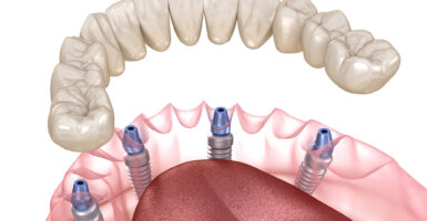 All-on-4 Dental Implants Explained